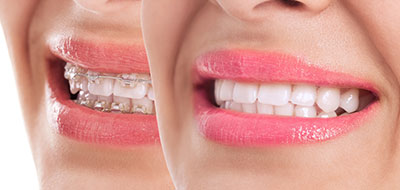 MCDental Care, PLLC | Veneers, Crowns  amp  Caps and Extractions