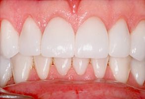 MCDental Care, PLLC | Teeth Whitening, Cosmetic Dentistry and Ceramic Crowns
