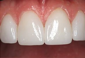 MCDental Care, PLLC | Snoring Appliances, SureSmile reg  Aligners and Ceramic Crowns