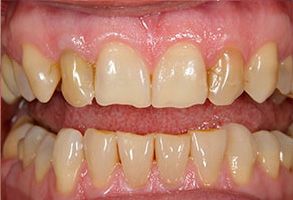 MCDental Care, PLLC | Sleep Apnea, Snoring Appliances and Ceramic Crowns