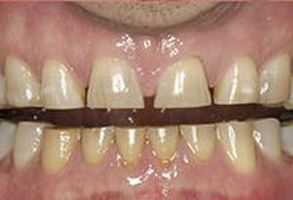 MCDental Care, PLLC | Preventative Program, Snoring Appliances and Emergency Treatment